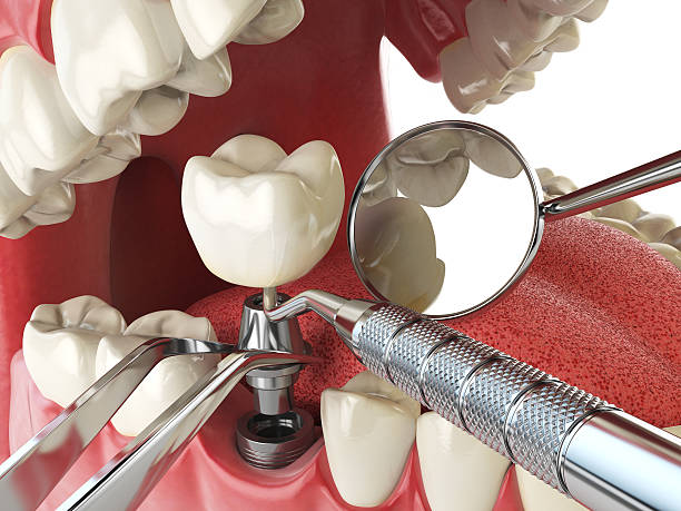 Best Emergency Root Canal Treatment in Santa Ana, CA